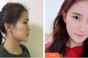 保定華仁皮膚病醫(yī)院激光美容中心李娟整形價(jià)格表附鼻部綜合案例展示