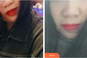 保定華美整形美容醫(yī)院魏繼鵬整形價格表附超聲波潔牙案例展示