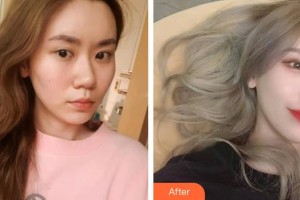 保定新視眼科醫(yī)院王鳳翔整形價格表附定點雙眼皮案例展示