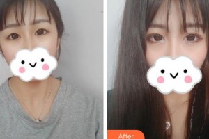 保定藍(lán)山醫(yī)療美容醫(yī)院周瑞芳整形價格表附眼部綜合案例展示