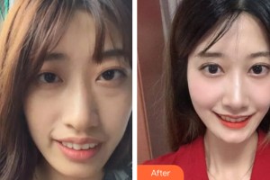 中山美南華整形美容醫(yī)院于建剛整形價(jià)格表附牙齒矯正案例展示