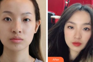 中山大學(xué)附屬第三醫(yī)院整形美容中心白莉整形價(jià)格表附植發(fā)案例展示