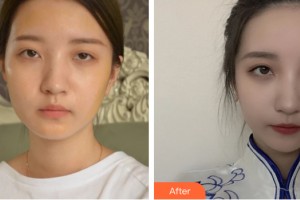 中山如花醫(yī)療美容門診部霍旺佳整形價(jià)格表附自體脂肪填充案例展示