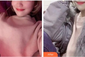 保定牙博士口腔醫(yī)院趙海紅整形價格表附超聲波潔牙案例展示