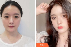 廣州倍生醫(yī)療美容門診部楊曉整形價格表附眼部手術(shù)案例展示