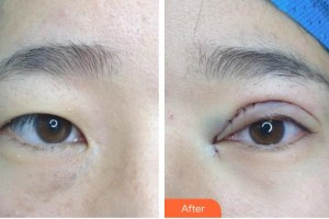 保定新視眼科醫(yī)院楊紅志整形價格表附眼部綜合案例展示