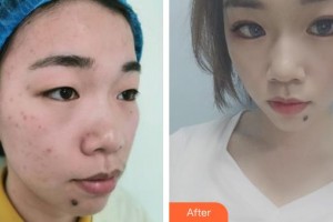 保定藍(lán)山醫(yī)療美容醫(yī)院于超整形價(jià)格表附定點(diǎn)雙眼皮案例展示