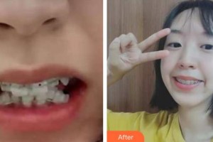 保定東陽口腔醫(yī)院興磊整形價(jià)格表附牙齒陶瓷矯正案例展示