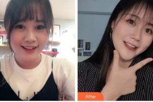 保定市口腔醫(yī)院金永強(qiáng)整形價(jià)格表附金屬托槽矯正案例展示