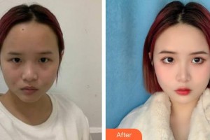 張家口市第四醫(yī)院整形美容科榮美玉整形價(jià)格表附激光祛斑案例展示