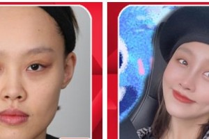 張家口市第四醫(yī)院整形美容科王志剛整形價(jià)格表附假體隆鼻案例展示