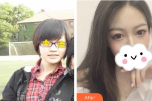 張家口維多利亞醫(yī)療美容醫(yī)院張立平整形價(jià)格表附硅膠隆鼻案例展示