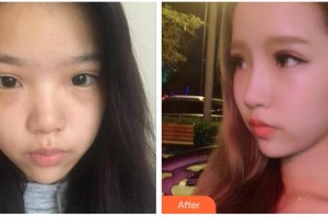 張家口維多利亞醫(yī)療美容醫(yī)院武成利整形價(jià)格表附鼻部綜合案例展示