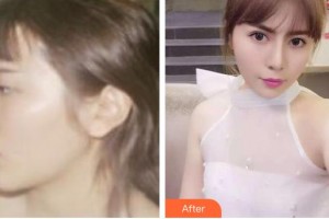 張家口維多利亞醫(yī)療美容醫(yī)院邱榮強(qiáng)整形價(jià)格表附鼻部綜合案例展示