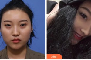 張家口維美醫(yī)療美容醫(yī)院姜濤整形價(jià)格表附埋線提升案例展示