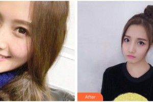 張家口維多利亞醫(yī)療美容醫(yī)院喻輝整形價(jià)格表附埋線提升案例展示