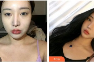 承德愛爾眼科醫(yī)院張節(jié)茹整形價(jià)格表附切開雙眼皮案例展示