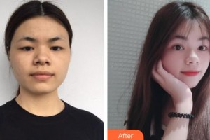 承德愛爾眼科醫(yī)院宋萬卿整形價(jià)格表附眼部綜合案例展示