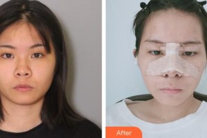 承德美天醫(yī)療美容醫(yī)院整形價(jià)格表附鼻部綜合案例展示