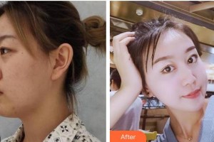 承德愛爾眼科醫(yī)院韓占南整形價(jià)格表附眼部綜合案例展示