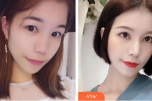 承德朝聚眼科醫(yī)院王占平整形價(jià)格表附眼部綜合案例展示