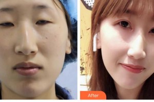 承德朝聚眼科醫(yī)院楊亞軍整形價(jià)格表附切開雙眼皮案例展示