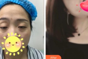 承德朝聚眼科醫(yī)院周海生整形價(jià)格表附眼部綜合案例展示