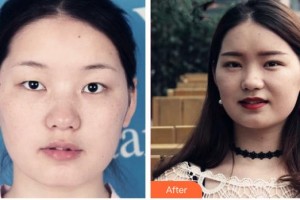 承德朝聚眼科醫(yī)院李寧東整形價(jià)格表附眼部綜合案例展示