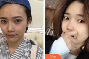 承德朝聚眼科醫(yī)院任曉宇整形價(jià)格表附內(nèi)切祛眼袋案例展示