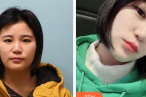 承德朝聚眼科醫(yī)院肖莉整形價(jià)格表附埋線雙眼皮案例展示