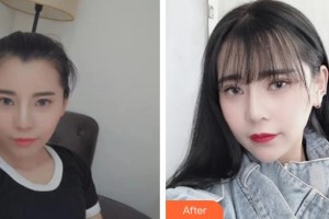 滄州瑞美醫(yī)療美容門診部胡勁松整形價(jià)格表附肋軟骨隆鼻案例展示