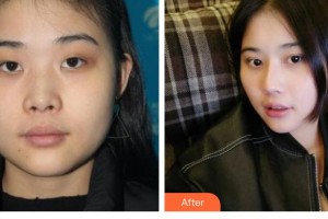 滄州奧拉克醫(yī)療美容醫(yī)院車景龍整形價格表附鼻部綜合案例展示