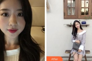 滄州中西醫(yī)結(jié)合醫(yī)院醫(yī)學美容整形科褚國華整形價格表附鼻部綜合案例展示