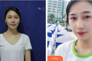 滄州楓華醫(yī)療美容診所羅偉整形價格表附鼻部綜合案例展示