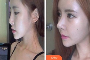 滄州楓華醫(yī)療美容診所肖麗芳整形價格表附鼻部綜合案例展示