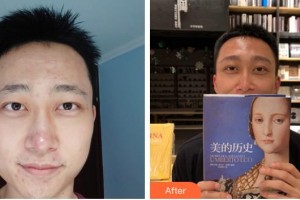 滄州奧拉克醫(yī)療美容醫(yī)院龍始恩整形價格表附種眉毛案例展示