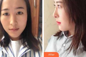 滄州京美醫(yī)療美容診所提曉華整形價格表附鼻部綜合案例展示