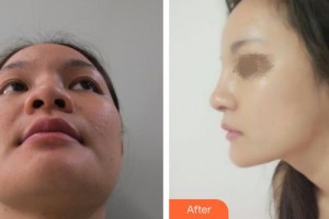 滄州靜港醫(yī)療美容診所羅忠振整形價格表附鼻部綜合案例展示