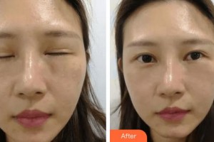 滄州靜港醫(yī)療美容診所路永洋整形價格表附眼部修復案例展示