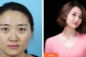 滄州眼科醫(yī)院周暢達整形價格表附切開雙眼皮案例展示