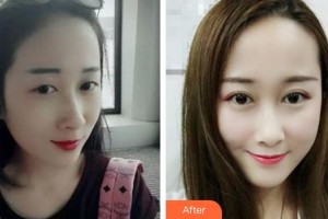 滄州眼科醫(yī)院陳忠飛整形價(jià)格表附眼部綜合案例展示