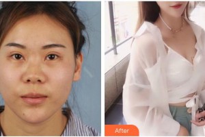 滄州眼科醫(yī)院張立友整形價(jià)格表附定點(diǎn)雙眼皮案例展示