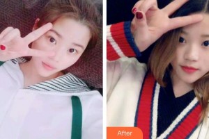 廊坊凱潤(rùn)婷（原悅美）醫(yī)療美容門診部張誠整形價(jià)格表附切開雙眼皮案例展示