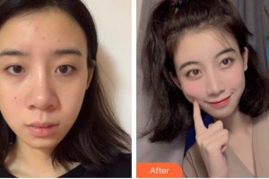 廊坊頤美佳醫(yī)療美容醫(yī)院范金財(cái)整形價(jià)格表附鼻部綜合案例展示