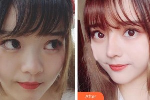 廊坊頤美佳醫(yī)療美容醫(yī)院黃綠萍整形價(jià)格表附鼻部綜合案例展示