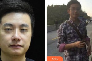 廊坊東方美容整形醫(yī)院孟亞秀整形價(jià)格表附熱拉提案例展示