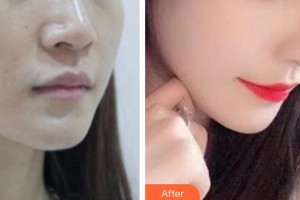 廊坊韓譽(yù)國都醫(yī)療美容診所石承瓚整形價(jià)格表附埋線提升案例展示