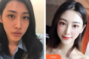 廊坊韓譽(yù)國都醫(yī)療美容診所張媛媛住院醫(yī)師整形價(jià)格表附埋線提升案例展示