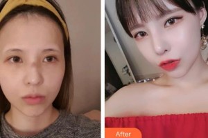 廊坊凱潤(rùn)婷（原悅美）醫(yī)療美容門診部鄭浩朱整形價(jià)格表附熱拉提案例展示