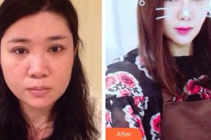 廊坊瑞美慧醫(yī)療美容診所余班林整形價(jià)格表附白瓷娃娃案例展示